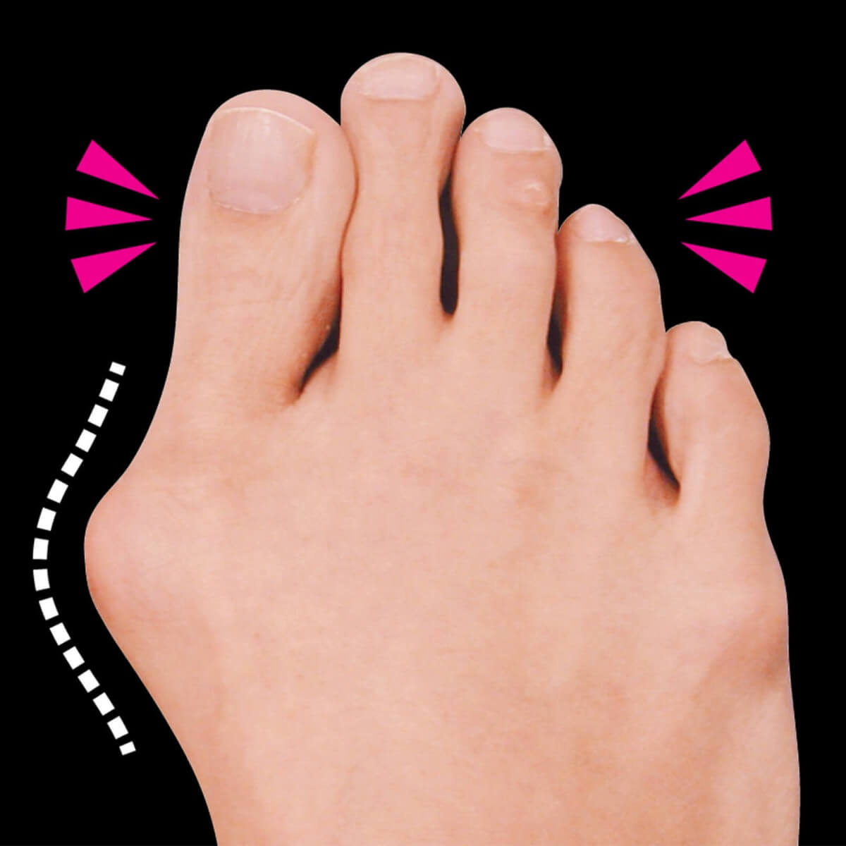 ズキズキ痛くてつらい外反母趾とは？母趾（足の親指）のつけ根が飛び出し、親指の関節が人差し指の方向へ「く」の字へ曲がる症状のことです。