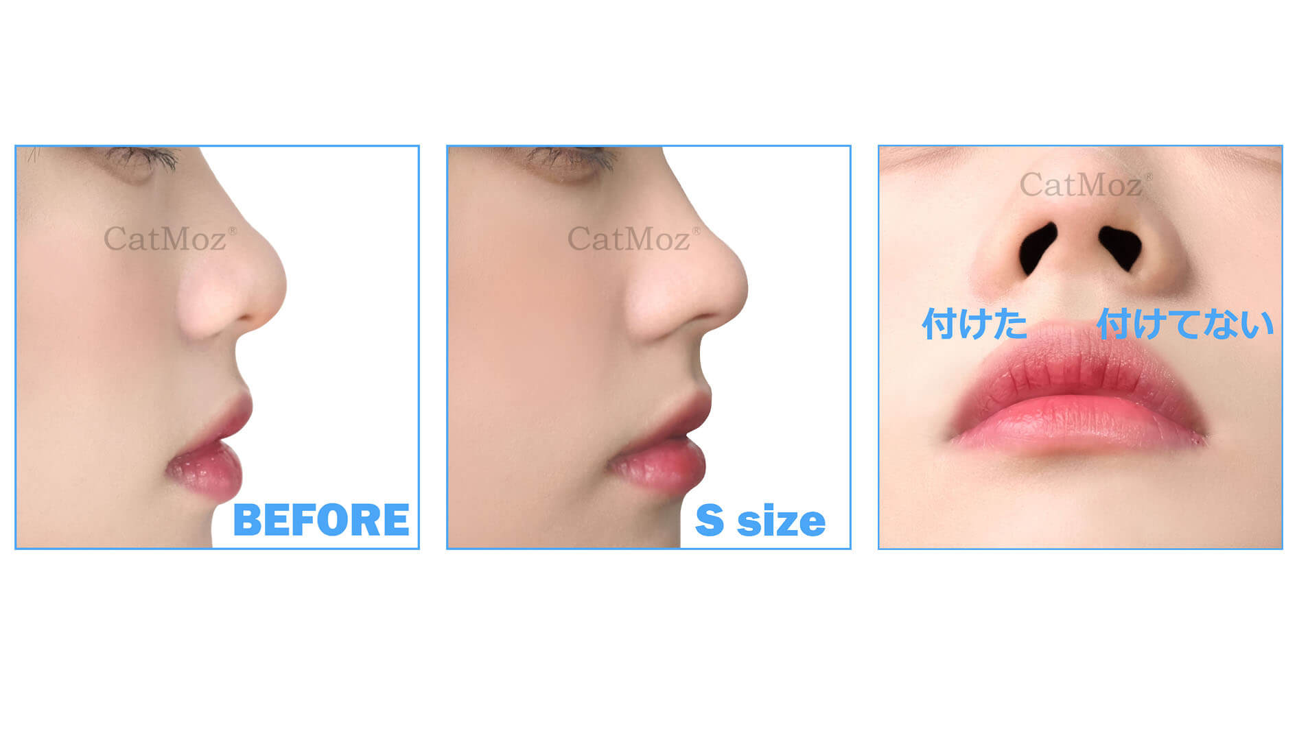 鼻プチのSサイズは、団子鼻が気になる方に適します。
